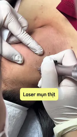 Lâu ko đăng b.ắ.n mụt thịt, BS vẫn làm thường xuyên nhé, mấy vị trí nhạy cảm da mỏng hay mọc nè 👩🏻‍⚕️. Nên làm sớm tránh lây lan í #drlahien #omeskin #munthit #banmunthit #laser #spahanoi 