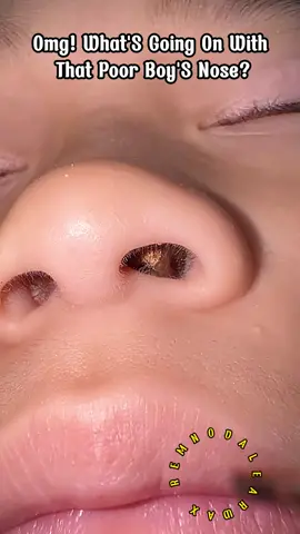 #foryou #earwax #earwaxremoval #earwaxcleaning #pimple #blackhead #earwaxremmoval #fyp 