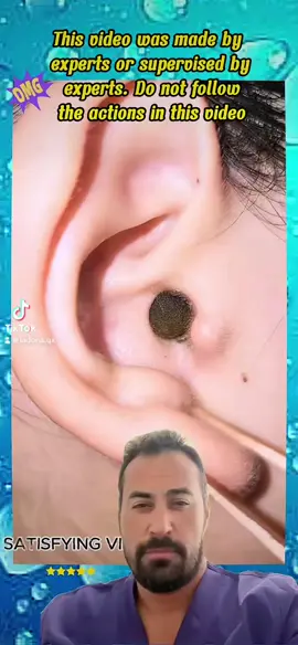 #pimple #pimplepop #acne #blackhead #pimplepops #asmr #satisfying #earwax #foryou #fyp 