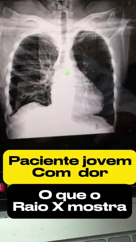 Dor nas costas em paciente jovem: A radiografia de tórax mostra o que ?