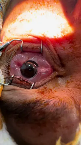 Cirurgia de PTERIGIO sem ponto. Com cola biologica . Aspecto vermelho do olho. Cresce com exposicao ao sol  #sol #cirurgia #pterigio #olhos #eyes #ojos #oftalmologia #ophthomology 