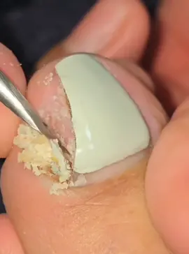 Lấy khoé siêu phê #laykhoechan #laykhoemongchan #laykhoemong #nail #nails #taovamich 