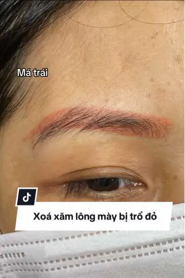 Xoá lông mày trổ đỏ chưa bao giờ là dễ dàng đối với những dòng máy laser lâu đời, không có bước sóng 532nm. Nếu không bắn đúng bước sóng thì lông mày có bắn 10 lần thì không những vẫn đỏ mà còn khiến da lông mày bị chai. Vì vậy hãy tìm hiểu kĩ trước khi các bạn đưa ra quyết định đi xoá xăm lông mày trổ đỏ để tránh 