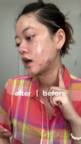 #skincareinfused @npureofficial #npurecushion #acneprone 