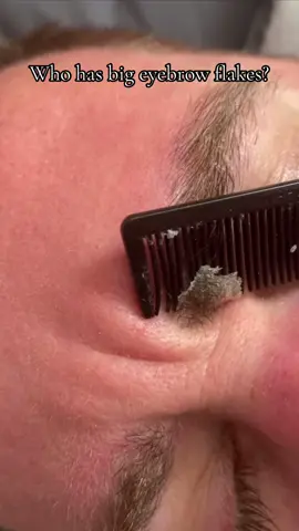 Big flakes asmr #asmr #asmrvideo #asmrsounds #asmrhair #asmrhairbrushing #asmrhairplay #hairplay #satisfying #oddlysatisfying #relaxing #scalpscratching #scalpscrub #scalpscrubbing #scratching #scratchingsoundsasmr #itchyscalp #scalpmassage #asmrsleep #tingles #triggers #asmrtriggers #asmrtingles #tingle #nitpicking #dandruffscratching #dandruff #flakes #scalpcheck #scalpcheckasmr  #hairplay #asmrhairplay  #psoriasis #psoriasisawareness  #seborrheicdermatitis #bigflakes #brows #eyebrows #facial #snowflakes 