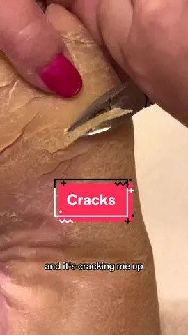 Replying to @Queen Warrior forgive the 🐸 voice! 😆 feeling loopy #callusremoval #parmeseanpalms 