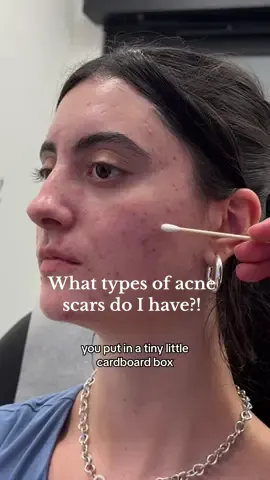 Let’s find out what types of scars I have and what’s next in my healing journey 🥰 full podcast episode debunking skin myths with Dr. Danny Guo on @LoudTalk with Lavi Podcast  ❤️ #skinpositivity #acnepositivity #unfilteredskin #acnetreatment #skincare #accutane #hormonalacne #acnescars #arazlo #retinol #tretinoin 