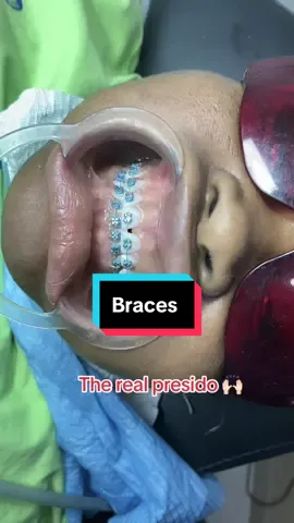 Use link in my bio to book an appointment 🙏#braces #teethcleaninginsangoota #fashion #fashionbraces #segunjohnsonmusician #presido #peller #fyp #goviral 