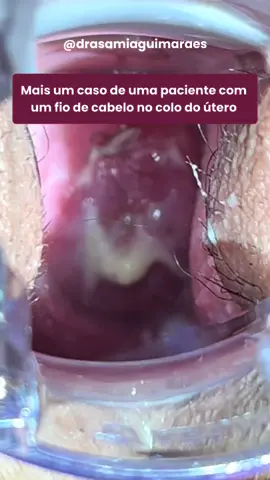 É mais comum do que parece. Apenas um fio de cabelo pode ser o responsável pelo desequilíbrio da sua flora v@gin@L, causando infecção e corrimentos, como foi o caso dessa paciente. Nunca se automedique. Procure um profissional habilitado para te examinar e prescrever o tratamento mais adequado.  • Sâmia Guimarães  Ginecologia e Obstetrícia  CRM-29.983 / RQE: 19006  #candidiase #candidiasederepeticao #corrimento #fiosecabelo #infeccao #saudedamulher #ginesamia 
