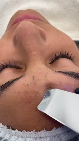 #foryou #foryoupage #foryourpage #skincaretips ##fyp #fypシ #fypage #blackhead #لبنان🇱🇧 #مصر #skincare #عناية_بالبشرة #beauty #morningroutine #morningskincareroutine #lebanon #pimples #تنظيف_البشرة #pimple #اكسبلور #pimplepop 