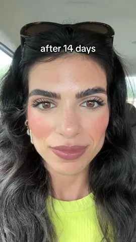 Before & after botox, ik merk nu al zoveel verschil!! Geen hoofdpijn meer voor moiiiii 🙂‍↕️ #fyp #foryou #botox #botoxtreatment #botoxbeforeafter #faceland #facelandnederland #frons 
