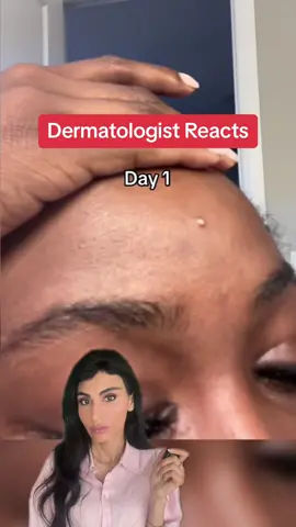 Should you pop your pimples? #acne #pimplepop  #summermakeup #acnetreatment