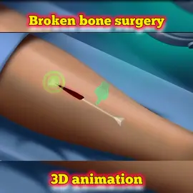 Broken bone surgery😌 #positivity #3danimation #viral #Science #gallbladderremoved #animation #Science #foryoupage #spinesurgery #anime #doctor #doctor #doctorstrange #positivevibes #positivity #foryoupage #foryou #viralvideo #viral 