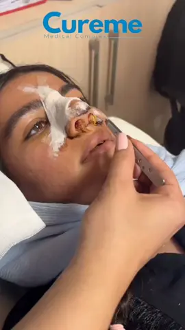 Say goodbye to nasal swelling! 2 days after surgery, our patients come in for a smooth removal of their tampons. Get a beautiful, natural-looking nose with our expert rhinoplasty procedures. #NoseJob #Rhinoplasty #NoseSurgery #NoseBeauty #FantasyNose #SurgicalBeauty #TamponRemoval #PostSurgeryCare #Laser #AcneScar #SkinSpots #HairTransplant #Beauty #Filler #Rejuvenation #SkinCare #EyebrowTransplant #Aesthetics #AntiAging #Botox #ChemicalPeel #CoolSculpting #DermalFillers #FacialRejuvenation #HairRemoval #LaserHairRemoval #LaserSkinTreatments #MedicalSpa #Microdermabrasion #Microneedling #NonSurgical #PlasticSurgery #RadioFrequency #SkinTightening #WrinkleReduction #YouthfulSkin #BeautyClinic #CosmeticDermatology #SkinHealth #AestheticMedicine #BodyContouring #FaceLift #Injectables #LaserResurfacing #SkinRejuvenation #cureme #curememedicalcomplex 