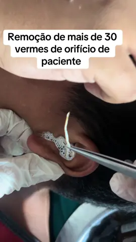 vermes em orifício de paciente #hospital #saudi #asmr #viral #fyp #capcut #saude #contaminacion #parasite 