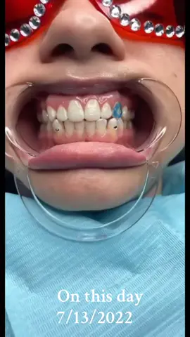#onthisday #idothis 🧚‍♀️ #fypage #toothgemtechnician #shaolinstoothfairy🧚‍♀️ #prestigious_smiles 🫶💋