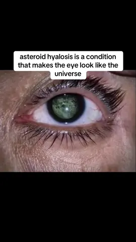 asteroid hyalosis is a medical condition that causes the eye to develop lots of glittering particles. #eye #interesting #fyp 