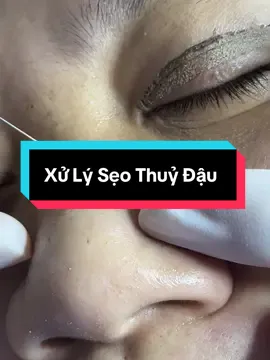 ♻️ XỬ LÝ SẸO LÕM DO THUỶ ĐẬU ĐỂ LẠI #coldplasma #plasma #plasmalanh #xoaseo #seothuydau #dieutriseolom #chuyengiaocongngheplasma #