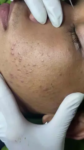 #pimple #blackheads Daily Satisfying Blackheads and Pimples Removals 