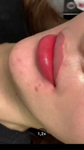 Xem hết clip để xem qtrinh Ly làm môi nha #phunmoi #khuthammoi #phunmoitunhien #saigon #xuhuong #viral 