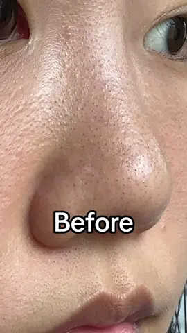 This product can be purchased on Amazon (https://a.co/d/gOmjg2v), Yesstyle, and Olive Young Global! :)  @FRANKLY @FRANKLY_GLOBAL  #franklyskincare #franklycloserserum #closerserum #peptideserum #amazonbeauty #amazonfinds #poreserum #poreminimizer #koreanskincare #tiktokmademebuyit #skintok #skincareviral #primeday #amazonprimeday 