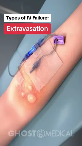 Intravenous (IV) therapy can encounter failures like extravasation, infiltration, and phlebitis.  Extravasation occurs when IV fluid leaks into surrounding tissue, causing pain, swelling, and potential tissue damage. Immediate cessation and appropriate interventions are crucial to prevent severe complications. Infiltration involves non-vesicant IV fluid leaking into surrounding tissue, leading to swelling and discomfort but generally less severe than extravasation. Management includes stopping the infusion, removing the IV, and applying warm compresses to aid fluid absorption. Phlebitis is the inflammation of a vein due to mechanical, chemical, or bacterial causes, presenting as redness, warmth, and pain. Treatment involves discontinuing the IV line, applying warm compresses, and administering anti-inflammatory medications. Proper catheter techniques and regular site inspections help prevent these complications. #ivfailure #medicaltiktok #educationalvideo #medicineexplained 