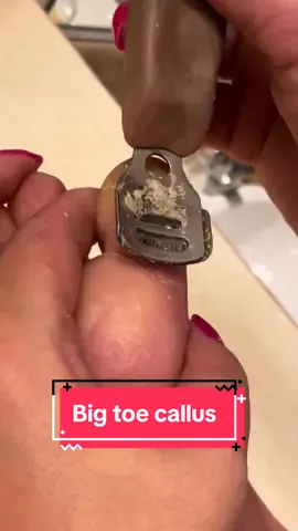 Replying to @Molly Carnall big toe callus removal #callusremoval #callusedfeet #parmeseanpalms 