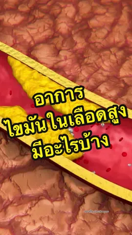 อาการไขมันในเลือดสูง มีอะไรบ้่าง?? #ไขมันในเลือดสูง #เบต้าออยล์ #betaoil #แม่นุ้ยเภสัช #อาหารเสริมลดไขมันในเลือด #เบต้าออยล์ร้านแม่นุ้ยนะคะ 