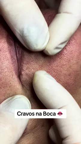 Limpeza de Pele! ❤️ #estetica #viral #viraltiktok #beleza #milium #limpezadepele #cravos #cravoseespinhas #comedaoaberto #espinhasgigantes #espinhas #espinhasecravos #rejuvenescimentofacial #cravonaboca 