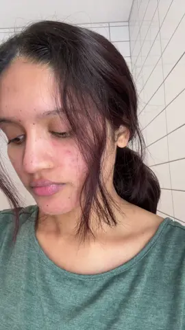 Pimple patch from @theinkeylist  #pimplepatch #pimplepatches #invisiblepatches #invisiblepatch #inkeylist #theinkeylist #acnepatch 