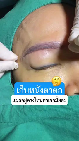 เก็บ #หนังตาตก ด้วยการทำ#หนังตาตกด้วยการทําผลใต้คิ้ว แผลอยู่ตรงไหนหาเจอกันมั้ยคะ🤔 #หมอสกาย #หมอตา #จักษุแพทย์ #ศัลยกรรมตา #ทําตาสองชั้น #subbrowlift 