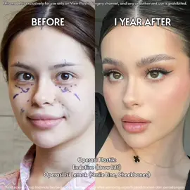 Hayley Bui had brow lift + fat graft (smile line, cheekbone)✨️ Copyrights to images and all other materials related to this content belong to View Plastic Surgery and you may be liable for unauthorized distribution and/or reproduction of the same without written consent. Results of surgery may vary depending on the individual, and there may be side effects such as hemorrhaging, inflammation, etc. #viewplasticsurgerykorea #plasticsurgerykorea #plasticsurgery #plasticsurgerybeforeafter #doubleeyelidsurgery #eyelidsurgery #rhinoplasty #nosejob #nosejobbeforeandafter #pointynose #facialcontouring #facecountouring #slimface #beautiful #nosesurgery #ptosiscorrection #ptosis #realreview #beforeafter #beforeandafter #threadlifting #threadlifts #추천 #shutupcountyourcalories #fatgrafting #korea #bts #legend #pretty #seoul #wonyoung #leeserafim #surgery #priscillasetio #surgerytiktok #drkim #viral #fypシ #foryoupage #fyp #beauty #BeautyTok #hacksandtips #성형 #과거와현재 #성형외과 #hacksandtips #drkim #BeautyTok #beauty #surgery #thailand #shikshakshok #nosejobcheck #GlowUp #underbite #overbite #dubaichocolate #hayleybui 