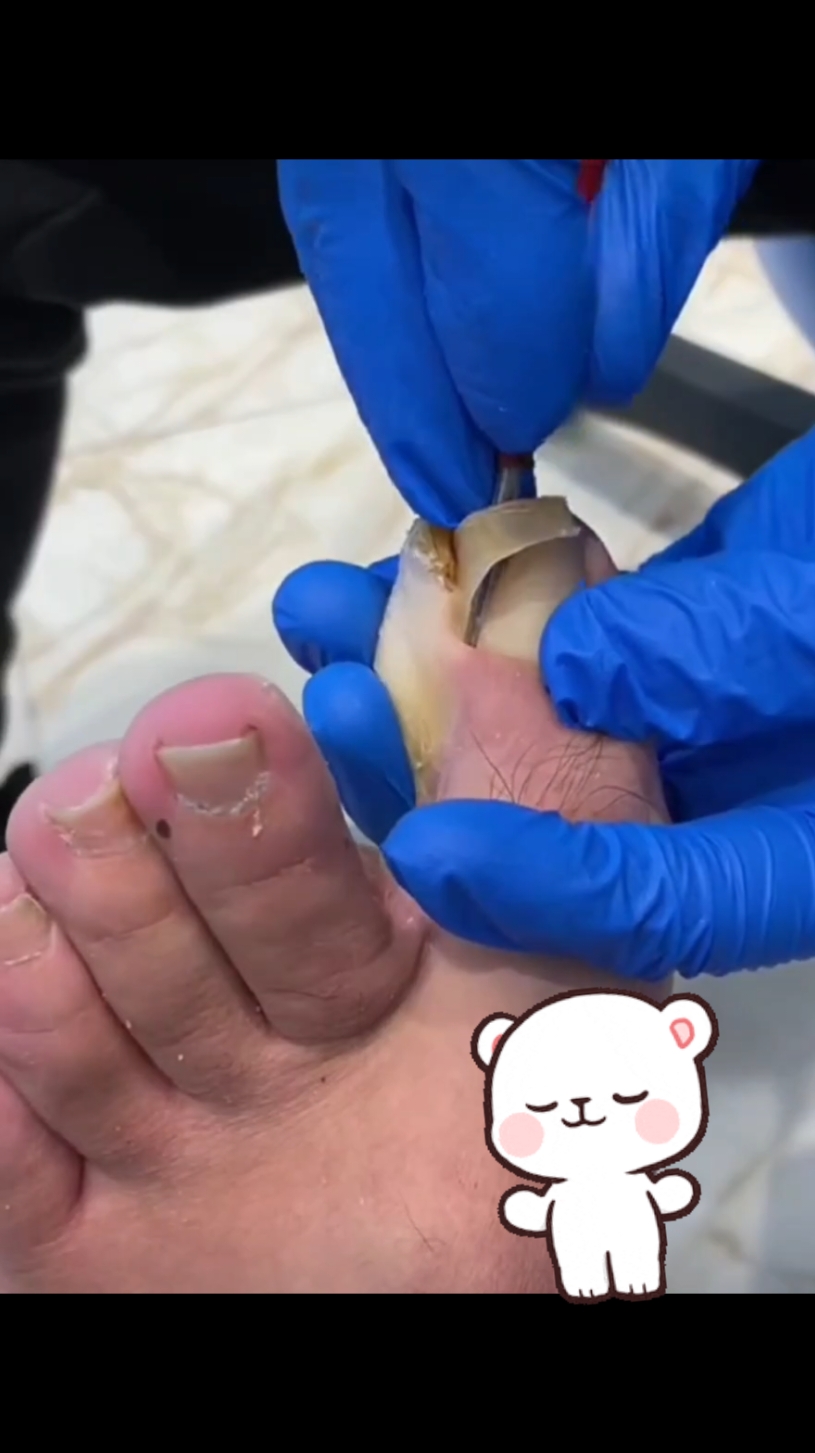 Satisfying ingrown toenail  removal #ingrownremoval #satisfyingvideo #idontowntherightstothisvideo 