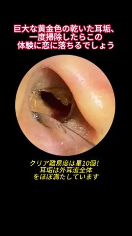 #earwax #earwaxremoval #satisfying #satisfyingvideo #asmr 