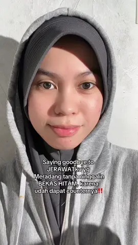 Totol jerawat anti ninggalin bekas‼️ #skincare #skincareviral #acnefighter #totoljerawat 