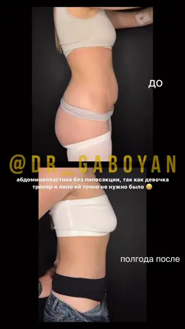 6 months after #abdominoplasty #abdominoplastia 6 месяцев после #абдоминопластика