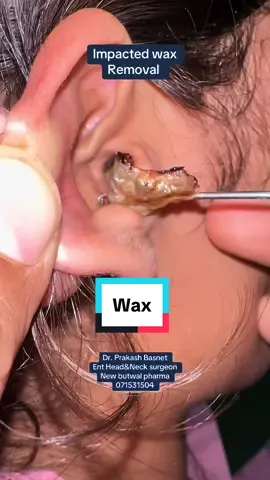 #foryou #foryoupage #viral #trending #fyp #fypシ゚viral #ent #entdoctorbutwal #entdoctor #wax 