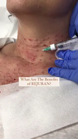 Treat the neck with REJURAN® - a unique skin booster that harnesses the power of bio-active DNA molecules, stimulating skin regeneration and collagen. This treatment involves micro injections into the skin. It is ideal to rejuvenate your neck, reducing the visible signs of ageing. REJURAN® PN/PDRN’s healing properties have several beneficial effects on the skin: - Improved skin elasticity and hydration - Reduced fine lines and wrinkles - Skin repair and skin barrier function - regulation of oil control and skin thickness - Improved skin tone - Improved Skin Texture REJURAN® can be injected in the following areas : face, including periorbital area (around the eyes), neck and Dec. #rejuran #rejuranhealer #rejurantreatment #skinbooster #skinboostertreatment #antiageing #brisbane_australia #brisbaneskinclinic #wrinkles #necklift 