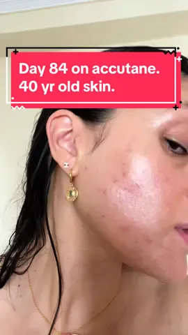 It’s day 84 of my accutane journey and so far I am loving the results. I’ve had no skin dryness or purging and my skin continues to improve. Just some PIE scarring left. I am an older person (40 years old) on accutane so i don’t know if that makes a difference to it’s efficacy. #accutanejourney #accutanecheck #skincare #acnetreatment #adultacne #acnefighter #acnejourney 