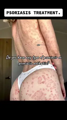 #lupusflare #lupuswarrior #lupusawareness #lupusstruggles#lupussucks #lupuslife #symptomsoflupus #justafew #butterflyrash #skinlesions #lupus #AXERatioChallenge #fy #autoimmunedisease#automimmunediseasewarrior#fightingautoimmnunedisease#justraisingawareness #flareups