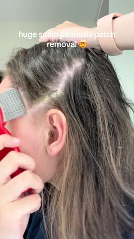 this patch at disney took out my hair a wee bit 😭 #psoriasis #scalppsoriasis #psoriasisremoval #satisfyingremoval #Psoriasispatches #scalppsoriasisremoval #psoriasisawareness #psoriasismanagement #psoriasiscommunity #psoriasistreatment #psoriasishelp #psoriasistok #scalppsoriasisrelief    