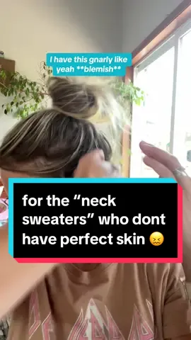 Less than $10 for the ONLY thing to rid me of my neck #acne 😖 @Y’OUR Skincare is the GOAT and ill tell anyone and everyone.  #ad #acne #adultacne #molluscumcontagiosum #sweat #yourskin #cleaningredients 