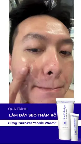 Quá trình làm đầy sẹo thâm rỗ cùng “Tiktoker Louis Phạm” #Rejuvaskin #rejuvaskinvietnam #siliconeyte #scarfx #scaresthetique #seoloi #seotham #reviewlamdep #kemtriseo 