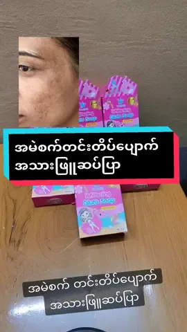 #vlovesoap #အမဲစက်၊တင်းတိပ်ရှိသူများအတွက် #viber09970650353 #သဃ်န်းကျွန်းdelifree #vloveskincaremyanmar #fyp #foryou 