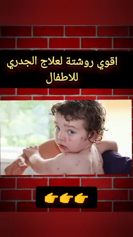 اقوي روشتة لعلاج الجدري للاطفال  #fyp #تيك  #تيك_توك  #تيكتوك  #تيك_توك_عرب  #تيك_توك_جدة   #تيك_توك_اطول  #تيك_توك_مصر  #تيك_توك_الامارات  #تيك_توك_فاشن  #tiktok  #tiktok  #tiktokindia  #tiktokuni  #tik_tok  #tiktoknews  #tiktokviral  #tiktoker 