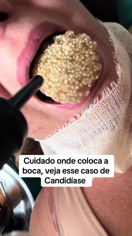 #candidiasis #boca #saude #saudi #asmr #capcut #hospital #contaminacion #viral cuidado onde coloca a boca, veja esse caso de candidíase 