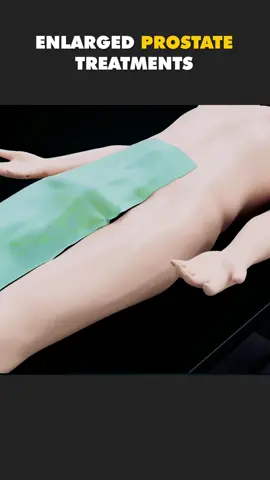 Enlarged Prostate Treatments 😱 (3D Animation) #enlargedprostate #prostatacancer #prostateproblems #treatmentofprostateenlargement #prostateenlargement #prostatesurgery #maleprostatecancer #medical3danimation #3dmedicalanimation 