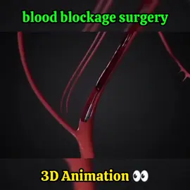 blood blockage surgery 👀.  #gallbladderremoved #scienceexperiments #spinesurgery ##doctorstrange #animals #animals #surgery #doctor #animation #Science #3danimation #3dzoompro #surgerytiktok #surgerytiktok #foryou ##viralvideo #viral 