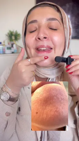 ازاي تتخلصي من clogged pores في خطوه بسيطه جدا ✌️