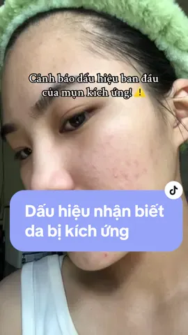 Da bị kích ứng hay còn gọi là beark out… Nếu không chú ý rất dễ để lâu bị nặng và khó chữa!   Việc đầu tiên làm khi da bị beark out là dừng các loại mỹ phẩm và truy tìm nguyên nhân khiến da bị breakout  #breakout #mụn #skincare #dakichung 
